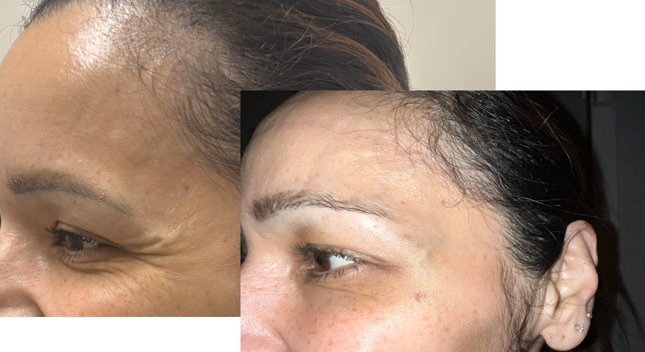 Botox before and after